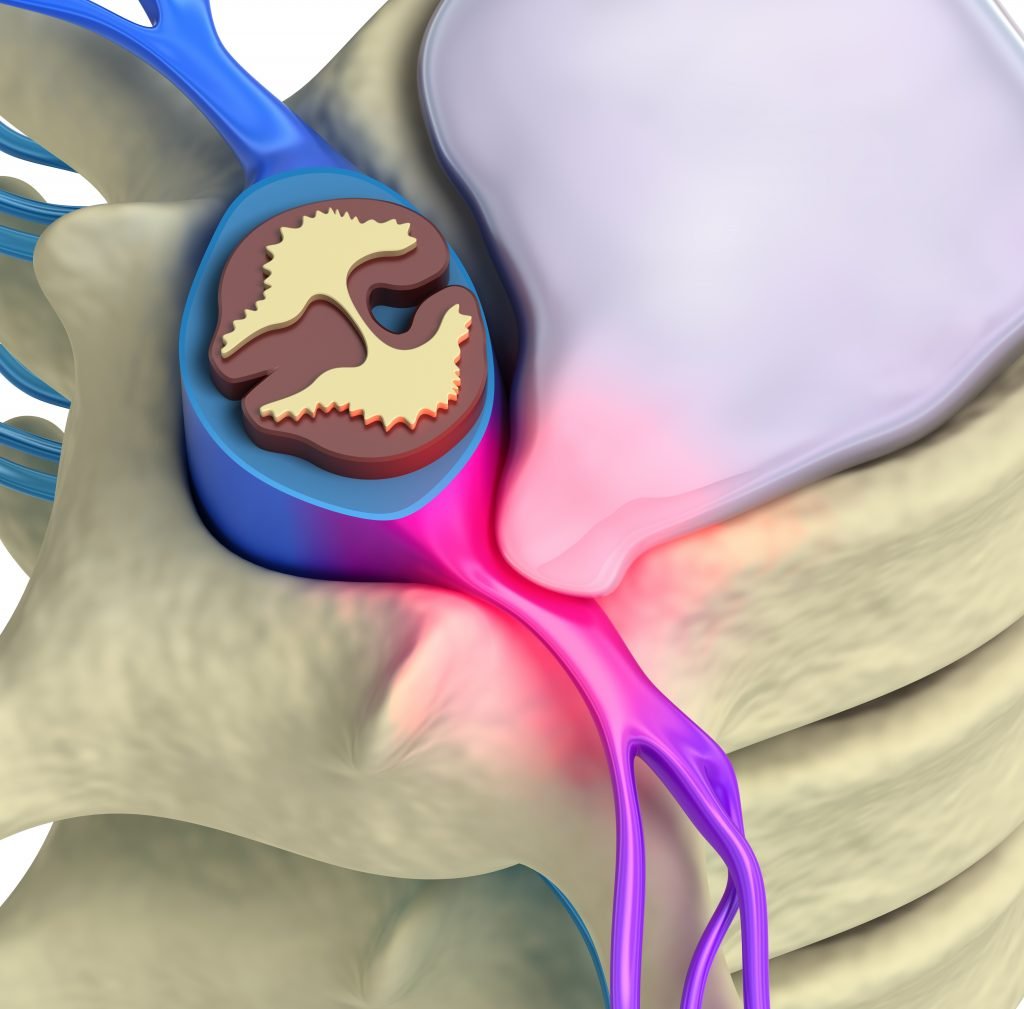 Protusão discal